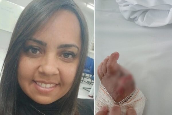 Mulher atropelada por caminhoneiro bêbado viu o namorado morrer, amputou o dedo e teme perder o pé: ‘Não quero perder mais’