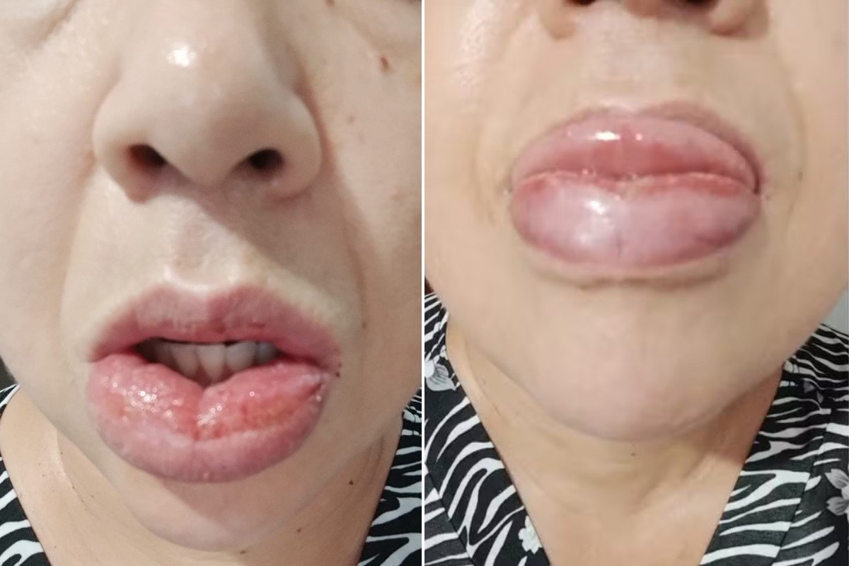 Educadora fica com a boca gigante após usar creme dental que teve a venda suspensa pela Anvisa