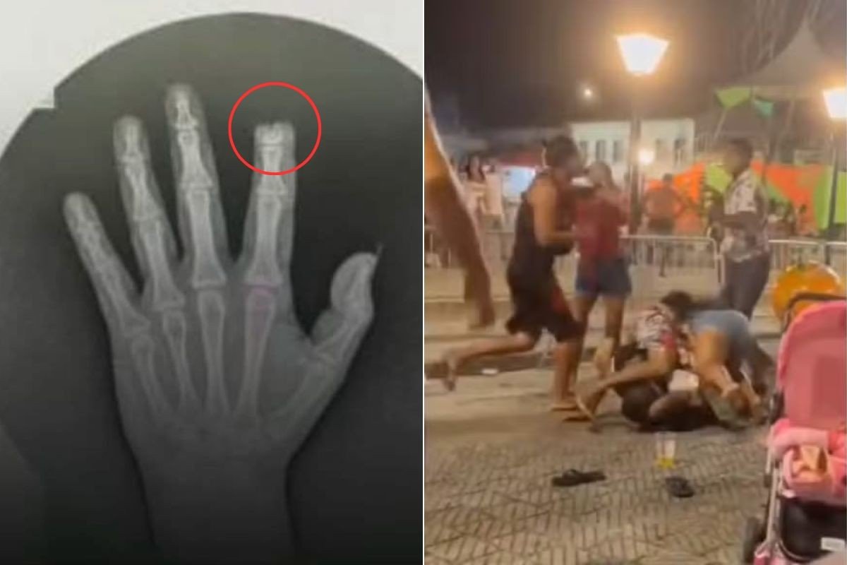 Raio-X revela dano na mão de mulher que teve dedo arrancado por mordida em briga familiar