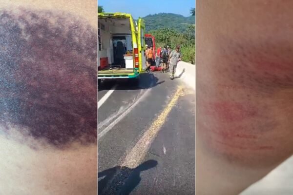 Justiça condena Ecovias a pagar indenização para ciclistas que caíram em buraco de rodovia no litoral de SP