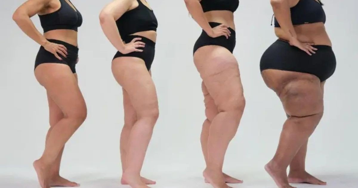 Lipedema: especialista explica o porquê estética é o último passo do tratamento