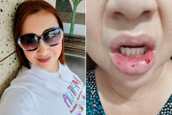 Mulher que ficou com a boca gigante após usar creme dental irá processar Colgate: ‘Fui motivo de chacota’