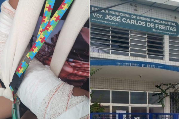 Menina autista é agredida e sofre fratura no pulso em escola do litoral de SP