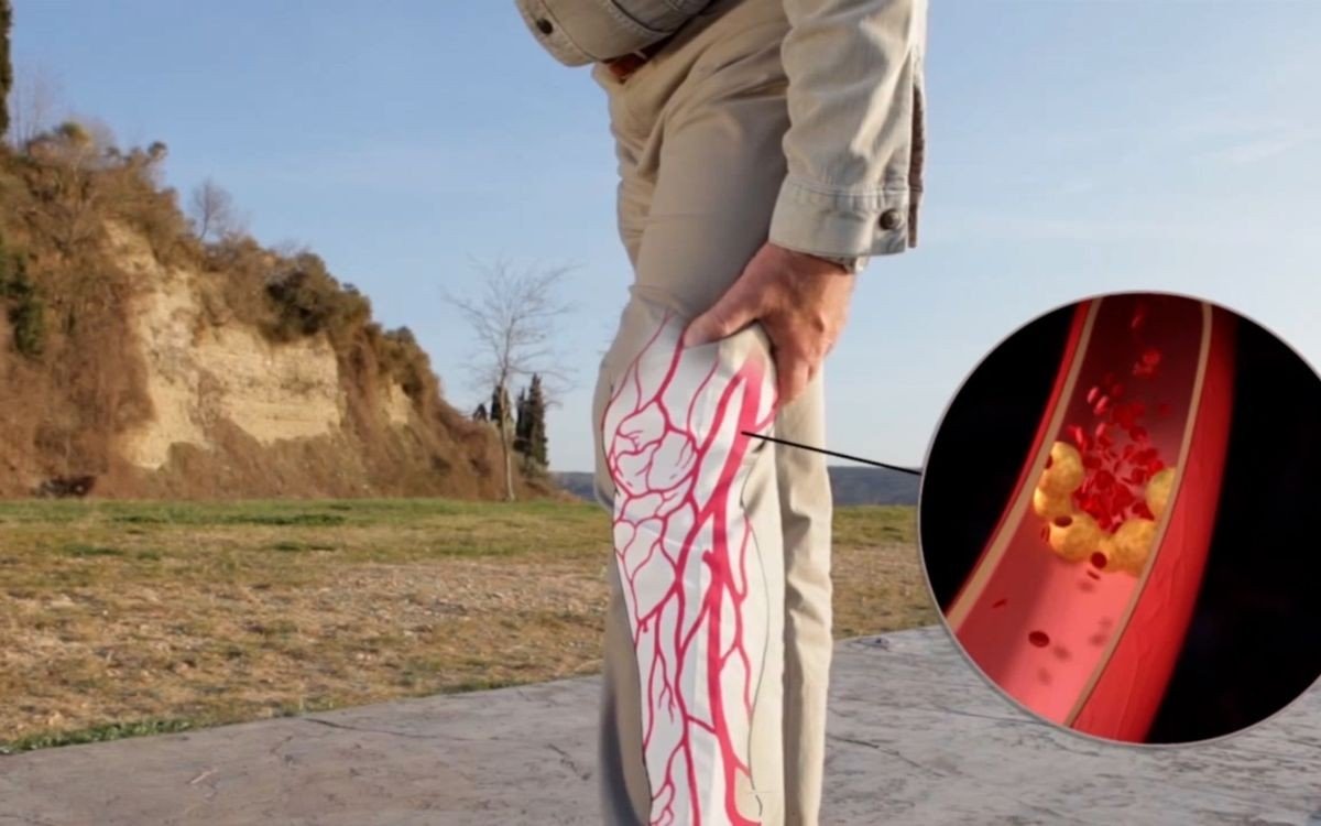 Teste indolor de apenas 1 minuto pode evitar infarto, AVC e amputações