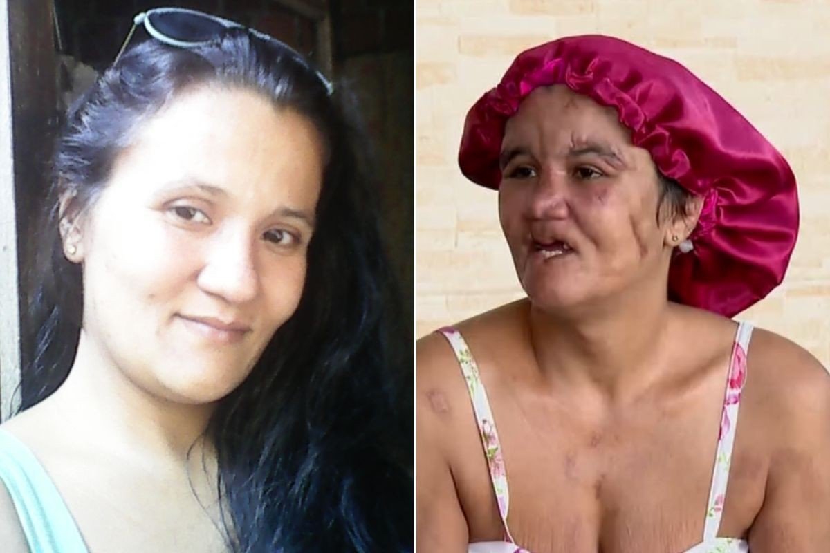 Mulher que teve couro cabeludo e dentes arrancados pelo companheiro busca recomeço: ‘Um pouco mais feliz’