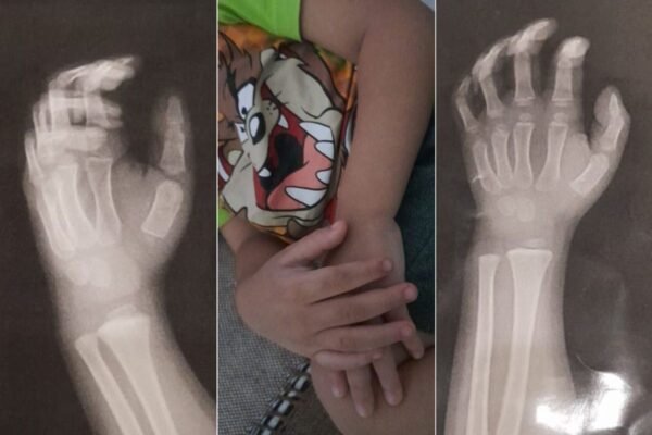 Menino de três anos agredido pela professora está com medo de ir à creche: ‘Pesadelo’, diz avó