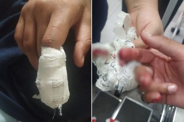 Menina tem o dedo decepado após mão ficar prensada em porta em escola estadual Menina tem o dedo decepado após mão ficar prensada em porta em escola estadual
