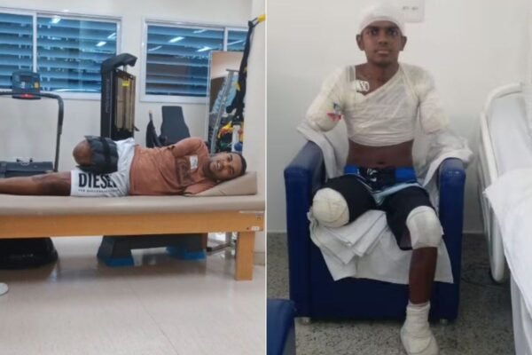 Adolescente que amputou braços, perna e parte de pé após levar choque se adapta à nova rotina: ‘Muito alegre’ Adolescente que amputou braços, perna e parte de pé após levar choque se adapta à nova rotina: ‘Muito alegre’