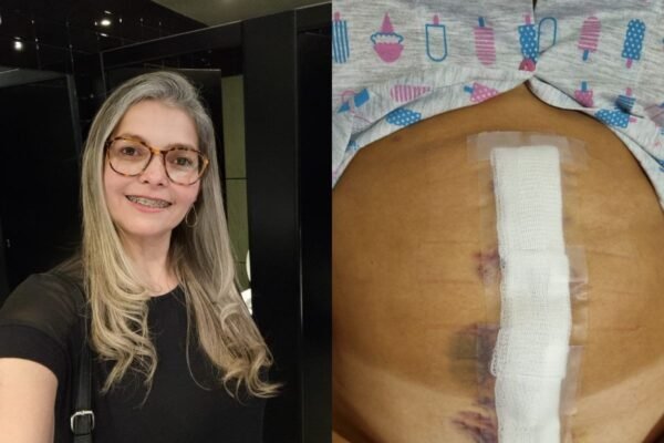 Sem sintomas, brasileira que vive na Irlanda descobre tumor raro de 20 cm em exames de rotina e busca ajuda: ‘tinha vida normal’