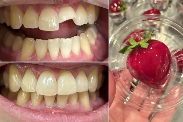 ‘Morango do Amor’ causa fraturas dentárias e dentistas alertam: ‘Bomba de açúcar’ ‘Morango do Amor’ causa fraturas dentárias e dentistas alertam: ‘Bomba de açúcar’