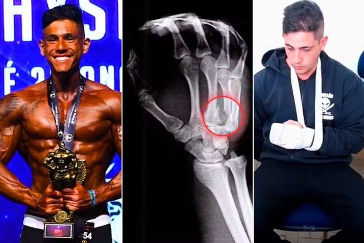 Fisiculturista preso por agredir namorada e quebrar a mão ainda não fez cirurgia, diz defesa