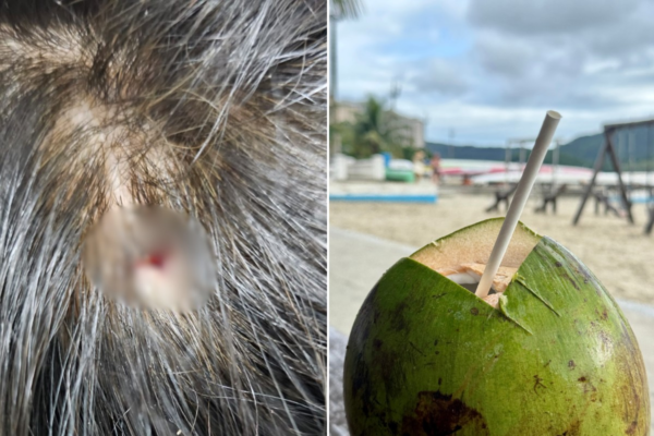 Facão quebra ao abrir coco e corta cabeça de mulher na orla de Santos, SP