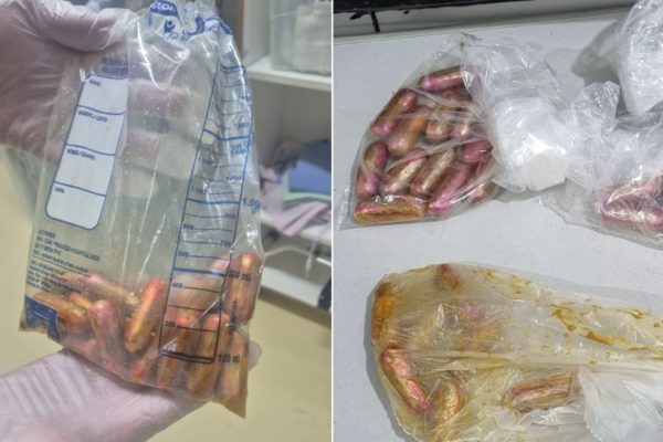 Boliviano é preso após relatar mal-estar em hospital e raio-X apontar cápsulas de drogas no intestino