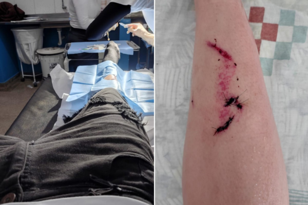 Jovem que caiu com arquibancada antes de show de Gian e Giovani diz que estrutura cedeu após estalo Jovem que caiu com arquibancada antes de show de Gian e Giovani diz que estrutura cedeu após estalo