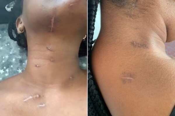 Mulher esfaqueada pelo ex enquanto filho dormia teve corda vocal atingida: ‘Ele dizia que me amava’, afirma